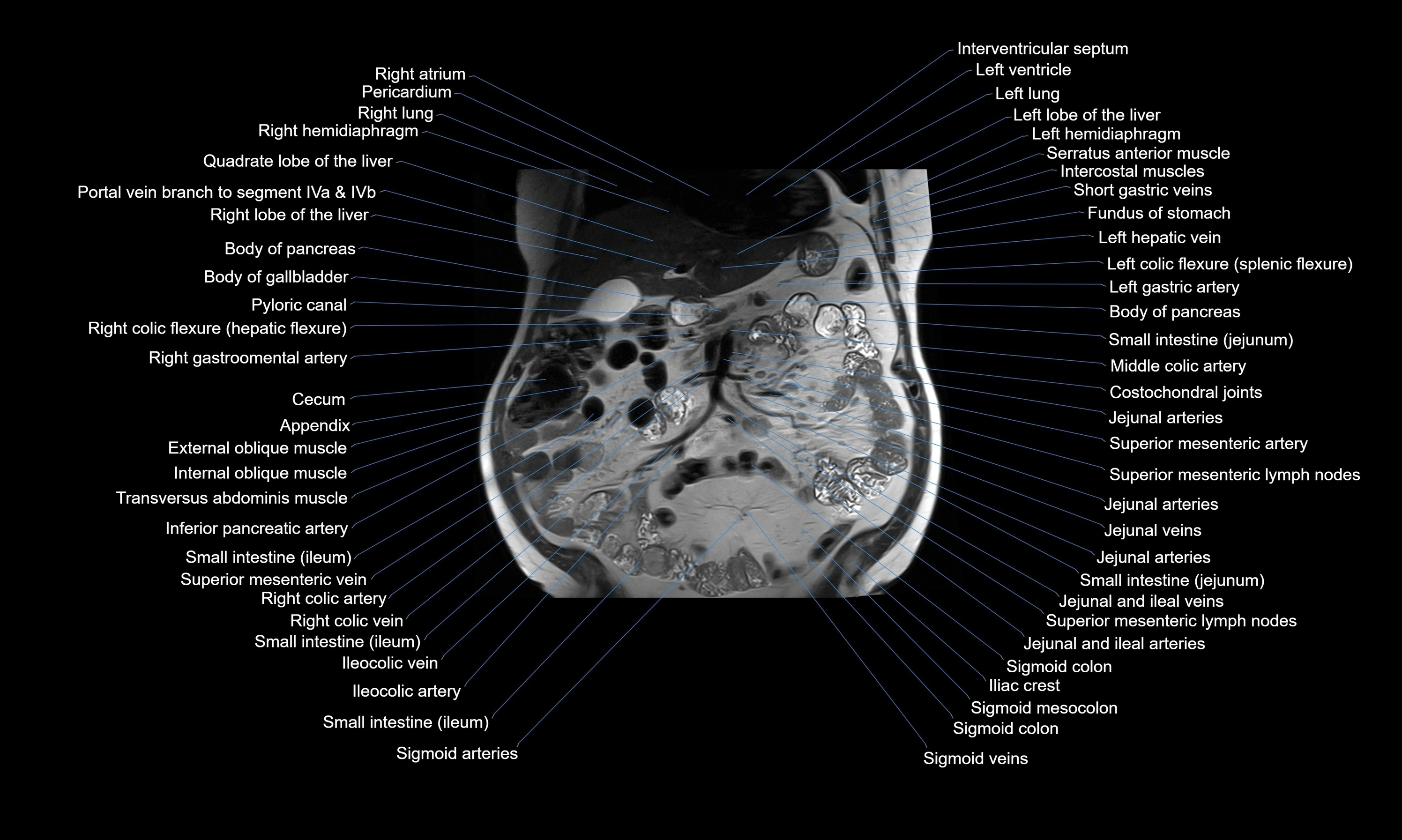MRI Abdomen axial cross sectional anatomy radiology  image-img-00001-00023.webp